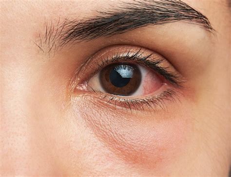12 Penyebab Mata Pedih, Merah, dan Cara Mengatasinya | HonestDocs