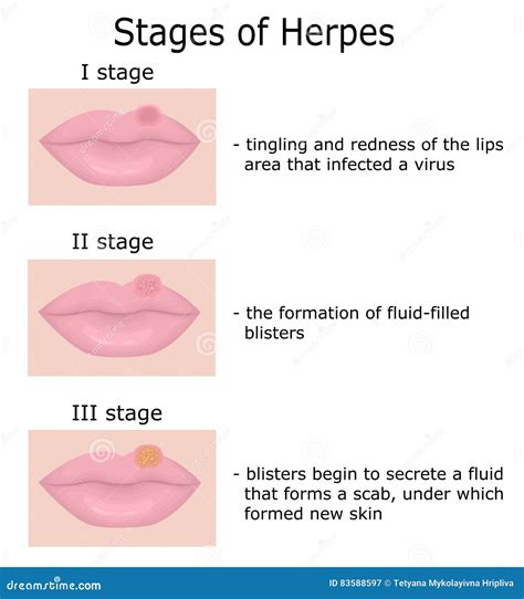 Herpes On Lips Symptoms , Lippenherpes (Herpes labialis): Ursachen ...