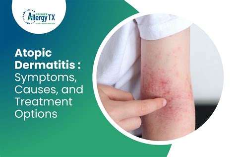 Atopic Dermatitis