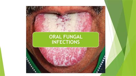 FUNGAL INFECTIONS OF ORAL CAVITY | PPTX | Dental Health | Diseases and Conditions