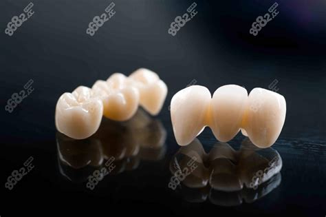 国产全瓷牙冠有哪些品牌?国产全瓷牙的品牌种类及价格介绍 - 口腔资讯 - 牙齿矫正网
