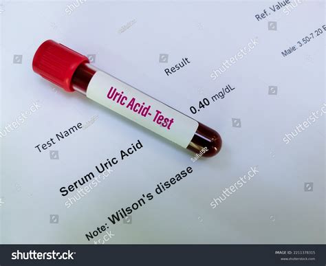 Uric Acid Blood Test