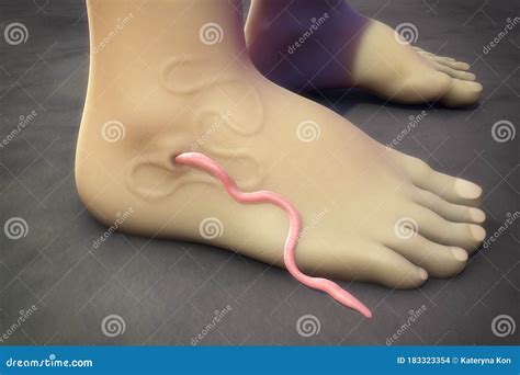 Guinea Worm Disease, Dracunculiasis Stock Illustration - Illustration of medinensis, disease ...