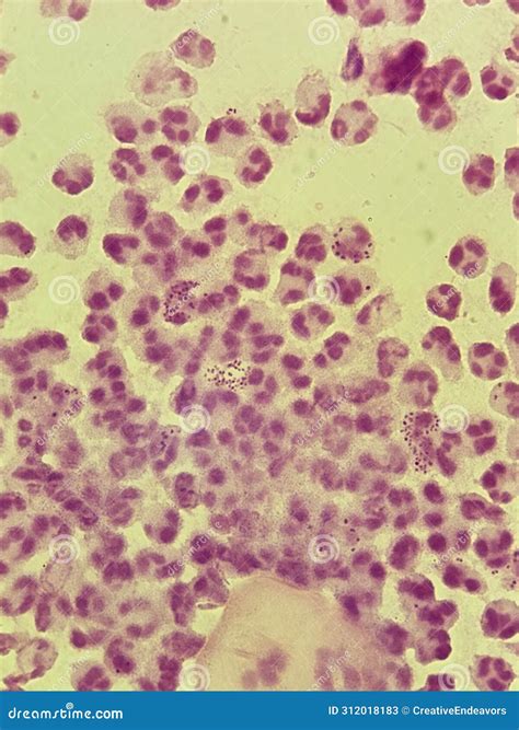 Neisseria Gonorrhea - Intracellular Gram Negative Diplococci Stock ...