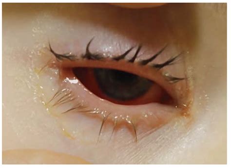 Unique Presentation of Mycoplasma pneumoniae-Induced Rash and Mucositis ...