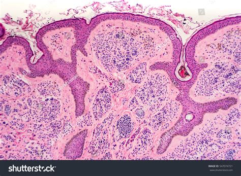 Skin Biopsy Microscopic Image Intradermal Nevus Stock Photo (Edit Now ...