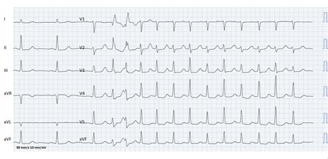 Aberrant conduction | ECG Guru - Instructor Resources