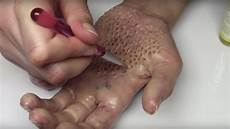 trou peau visage homme trypophobia what is it test cause cure photos trou peau visage homme trypophobia what is it test cause cure photos