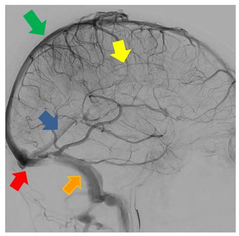 Inferior Sagittal Sinus
