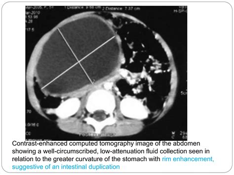 Intra abdominal cysts in children | PPTX