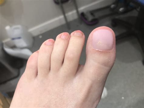 Pedique Cosmetic Nail Replacment | A&A Podiatrists & Chiropodists