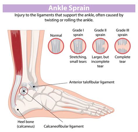 High Ankle Sprain – Symptoms, Treatments, Recovery...