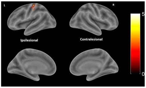 Impact of Brain Lesion Characteristics on Motor Function and Cortical ...