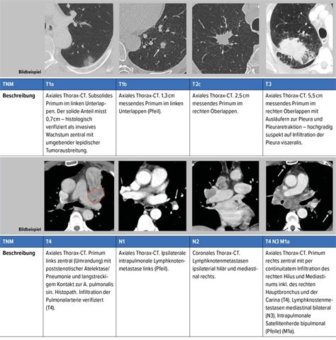 Staging Lungenkarzinom – die radiologische Perspektive - Onkologie ...