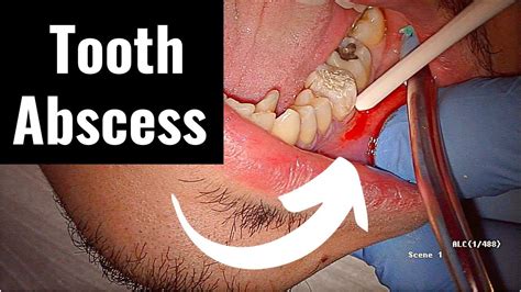 Image result for Abscess Tooth Extraction