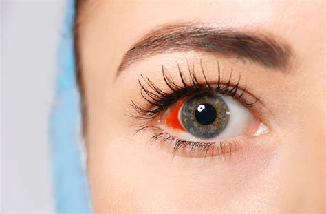 Are Broken Blood Vessels in Your Eye Dangerous? | Mississauga