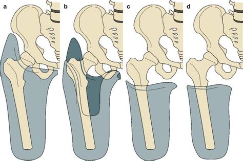 Ischial Containment Socket Workshop, المؤسسة الهندسية, Amman, 13 ...