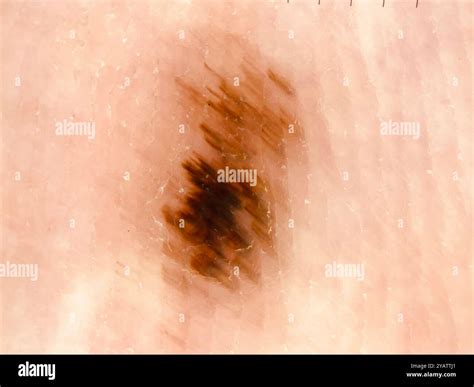 Dermatoscope image of a mole on the sole of the foot of an African-American female patient. This ...