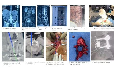Rare Spinal Cancer in 10-Year-Old Treated Successfully