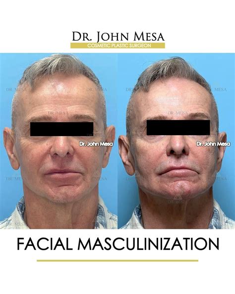 Facial Masculinization Before & After Photos | Dr. Mesa
