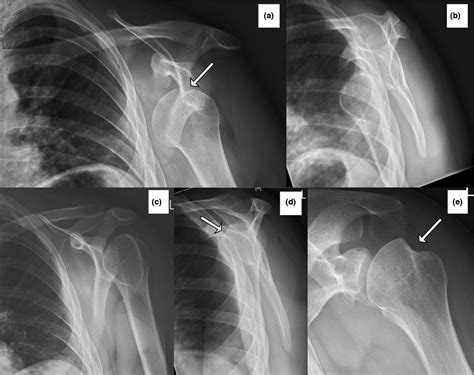 Coracoid Process X Ray