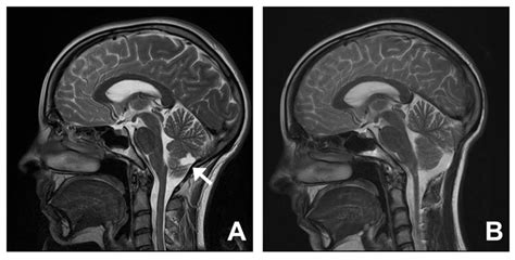 Low Lying Cerebellar Tonsils