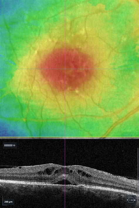 Cystoid macular edema – Retinography