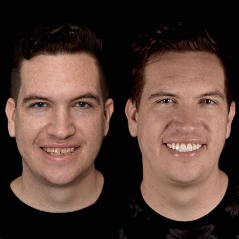 Gallery: Before and After Dental Veneers in Los Angeles, CA | Smiles By Dr. P