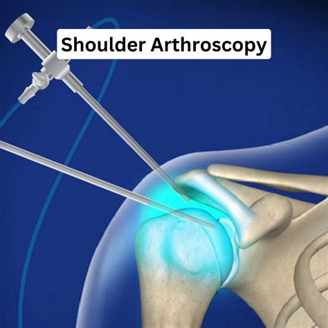 Best Shoulder Arthroscopy Surgery Doctors in Kolkata