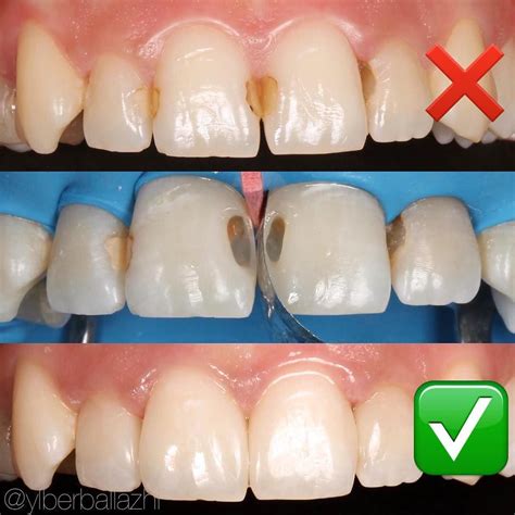 Dental Fillings Front Teeth