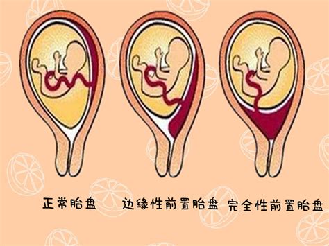 孕期出现胎盘前置，和这些因素脱不了干系，希望你能幸运规避__凤凰网