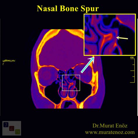 Nasal Bone Spur Removal Can Reduce The Your Headache!