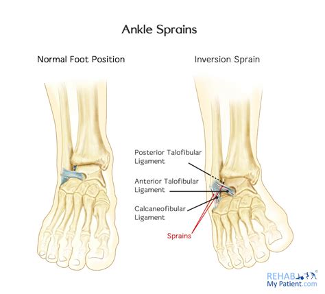 Ankle Sprains (Medial and Lateral) | Rehab My Patient