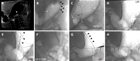 Percutaneous Endoscopic Gastrostomy Tube Placement Cpt Code at Shelly Ahmed blog