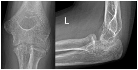 Coronoid Process Radiography