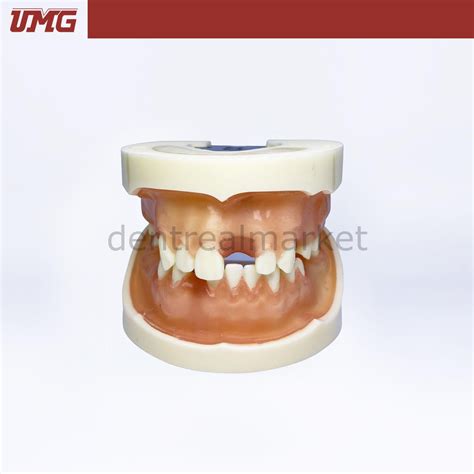 Umg Dental - Umg Model Implant Training Model Upper-Lower Jaw - UM-2002 ...