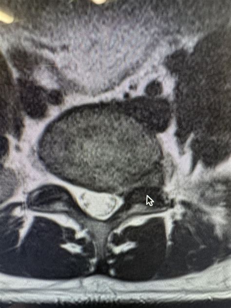 Disc desiccation, torn, and ruptured discs : r/SpineSurgery