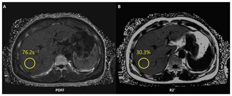 Non-Invasive Imaging Methods to Evaluate Non-Alcoholic Fatty Liver ...