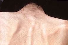 Downy Hair Anorexia by Anorexia And Bulimia Warning Signs Downy Hair Anorexia