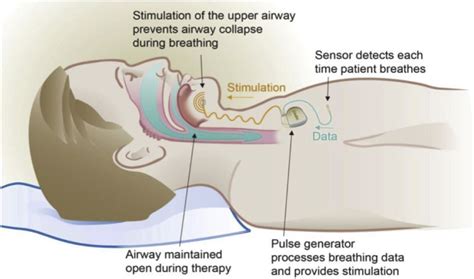 Novel Surgical Approaches for the Treatment of Obstructive Sleep Apnea - Sleep Medicine Clinics