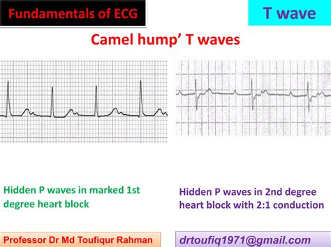 Approach to a patient with T wave abnormality in ECG | PPSX