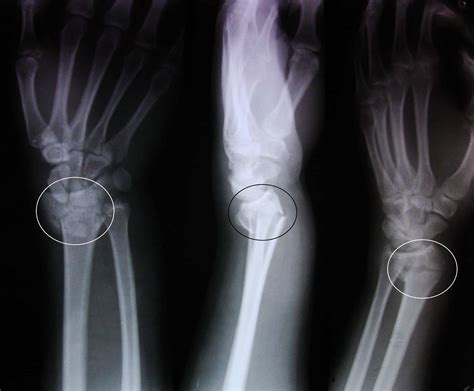 Explaining What Smith's Fracture Is - Physioroom Blog