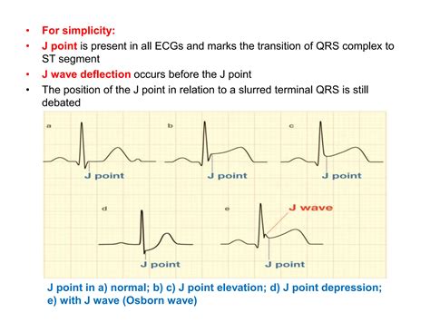 J POINT IN ECG AND ITS INERPRETATION IN ECG | PPTX
