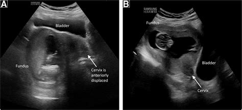 Incarcerated gravid uterus: a new treatment using the transvaginal ...