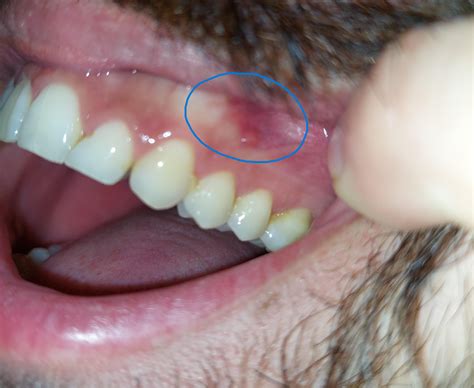 Red/clear-ish bump on my gums. It (re)appears ocassionally. Its not ...