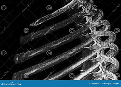 Chest CAT- SCAN of Rib Fracture. Medical Themes Stock Image - Image of lung, system: 307154631