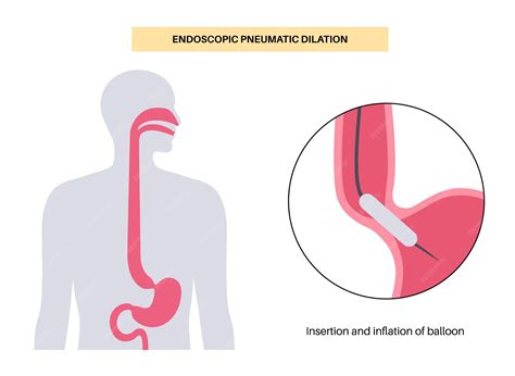 Premium Vector | Endoscopic pneumatic dilation upper endoscopy ...