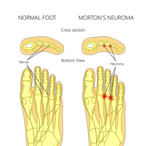 Pinched Nerve In Foot