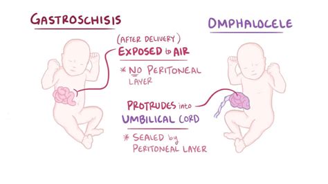 Gastroschisis Vs Omphalocele
