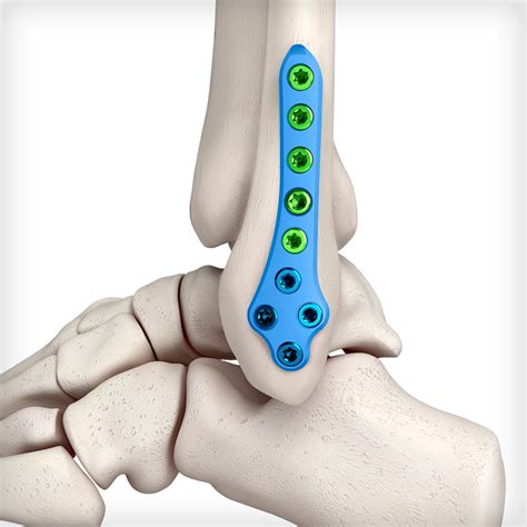 Metal Plate In Ankle Causing Pain at Karla Trent blog